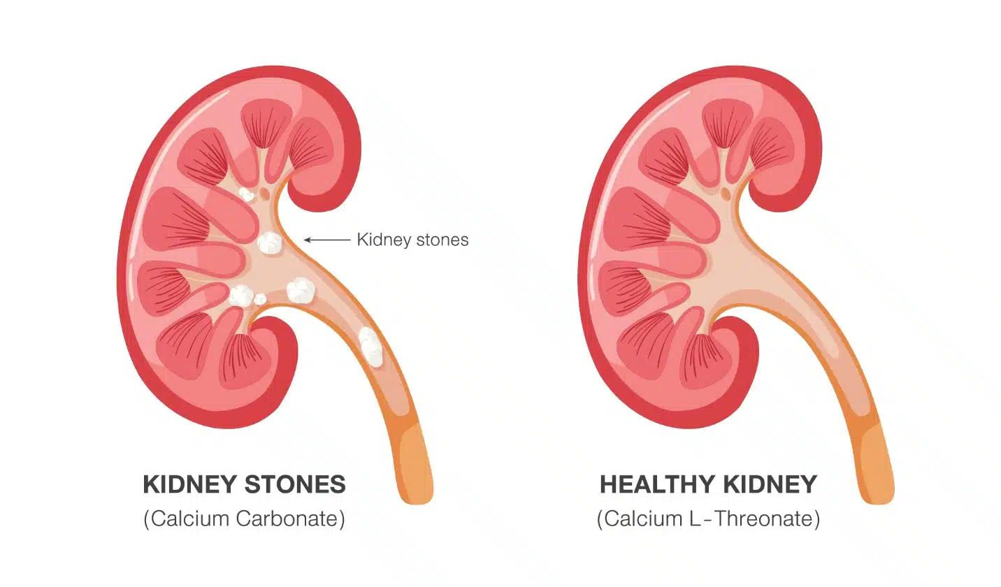 Kidney-stones02.jpg